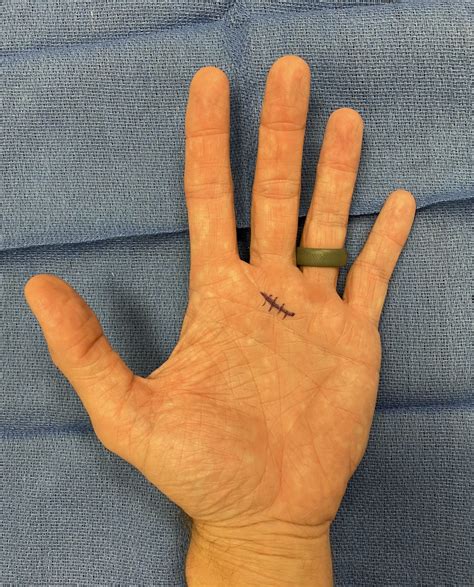 Trigger Finger Surgery: Relieve Pain and Restore Mobility Quickly