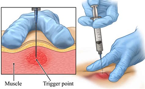 Relieve Pain with Targeted Trigger Point Injection Therapy Today