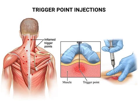 Relieve Pain with Targeted Trigger Point Injections Therapy Today