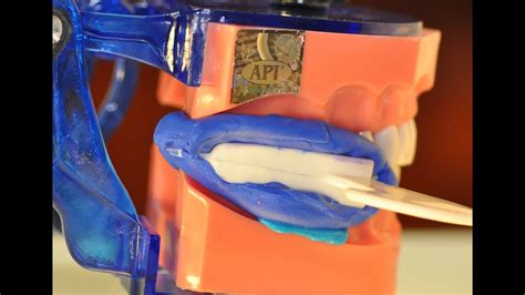 Triple Tray Impression Technique