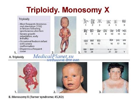 Triploidy Human