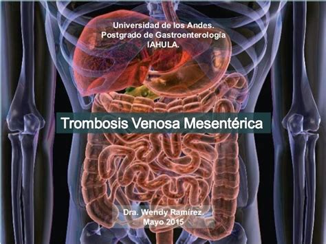 trombosis mesenterica aguda