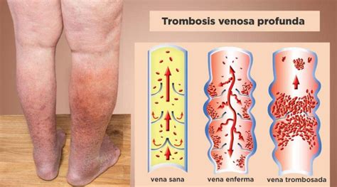 trombosis sintomas pierna