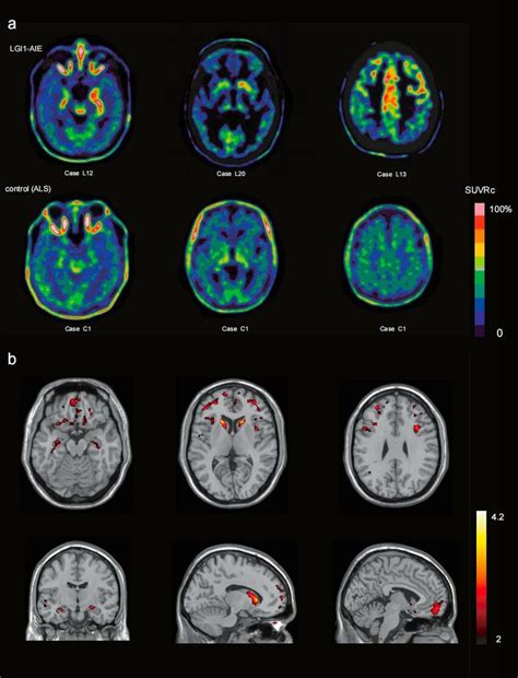 tspo pet imaging