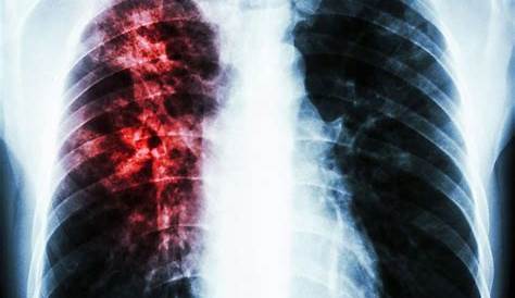 Tuberculosis Lungs Cavitating Pulmonary Gross Pathology Image