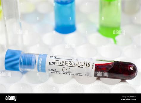 Understanding Tuberculosis Shot Positive Results Explained Simply
