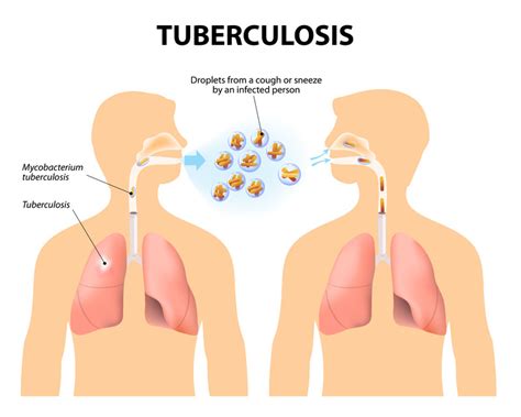 tuberculosis what does it do