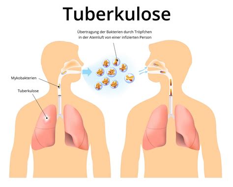 tuberkulose ansteckend