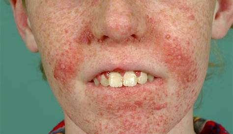 Tuberous sclerosis complex presenting as periungual