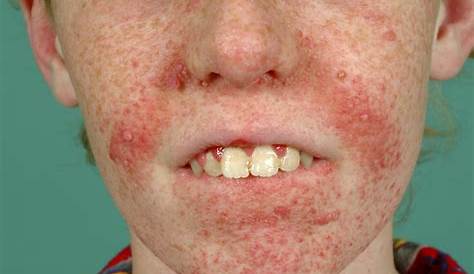 Tuberous Sclerosis Pictures 1 Symptoms And Causes