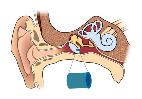 Understanding Tubes in Ears: What You Need to Know About Tympanostomy Tubes