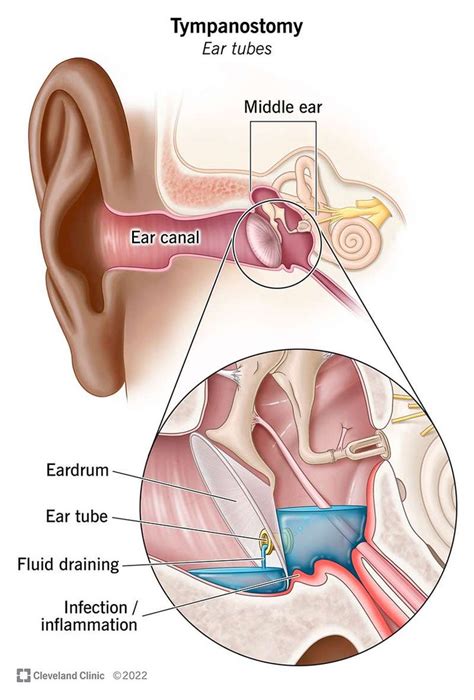 Tubes in Ears Surgery: A Simple Solution for Relief