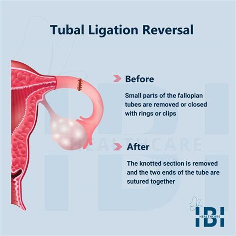 Reversing Tubes Tied: What You Need to Know About Tubal Reversal Surgery