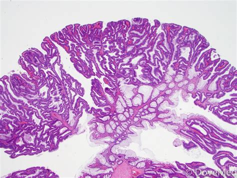 tubular adenoma fragment colonoscopy