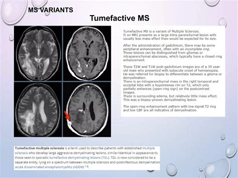 tumefactive ms prognosis
