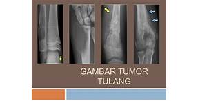 tumor tulang