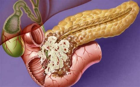 tumore al pancreas sintomi prima della morte