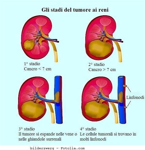 tumore al rene metastasi