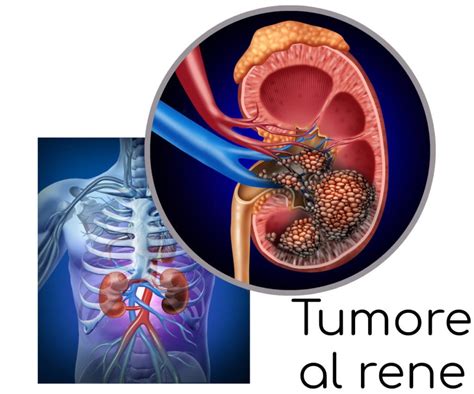 tumore al rene rischio di recidiva