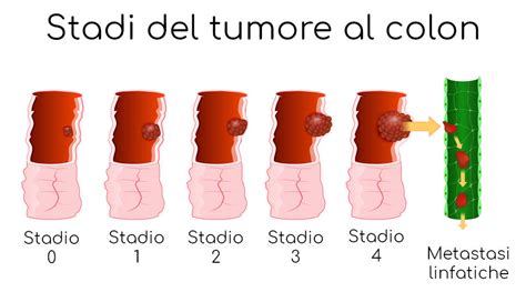 tumore ano sintomi iniziali