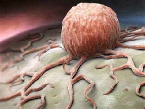 tumore in metastasi quanto si vive