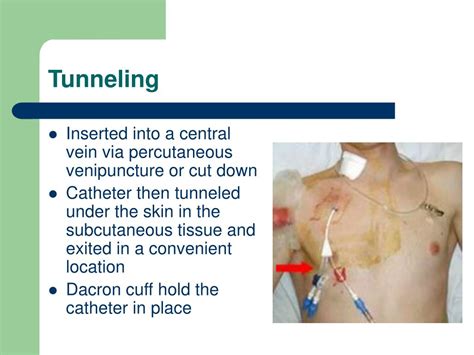 tunneled central venous catheter maintenance