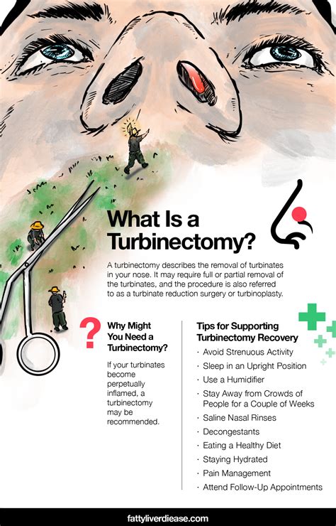 turbinectomy surgery cost