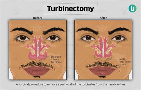 turbinectomy surgery video