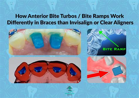 Turbo Bites Braces