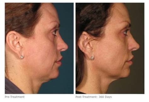 Lose A Turkey Neck With Kybella The Cosmetic & Skin Surgery Center