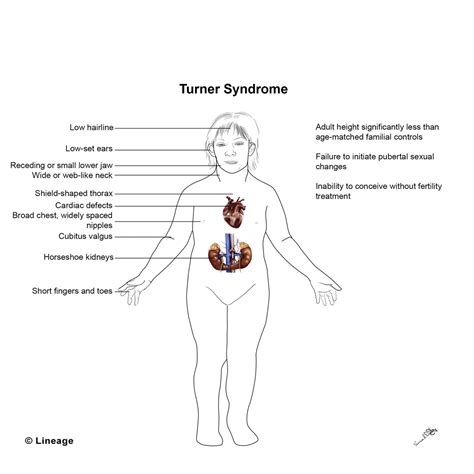 Turners Syndrome Notes