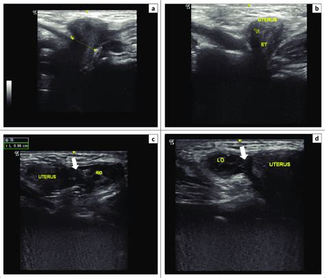 tuss ultrassom região inguinal