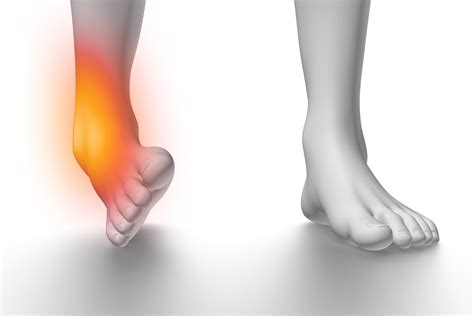 Recovering from a Sprain: What to Do After You've Twisted an Ankle