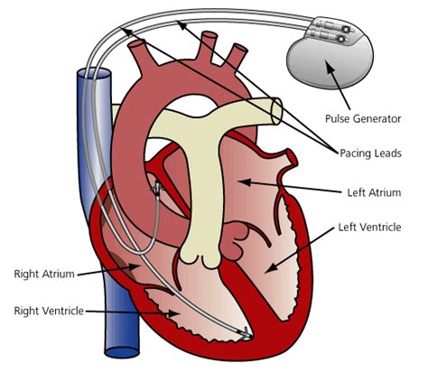 two lead pacemaker lead placement