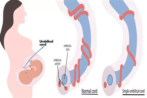 Understanding the Risks and Benefits of a Two Vessel Cord: What Expectant Mothers Need to Know