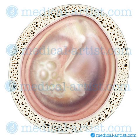 Tympanic Membrane Serous Effusion