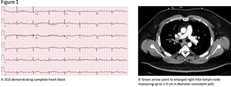 Type 1 Heart Block Icd 10