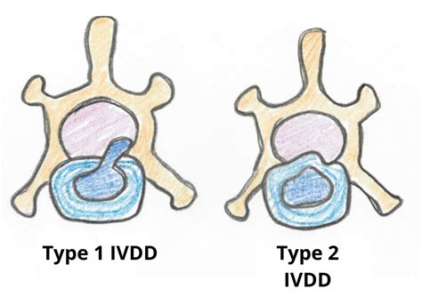 type 1 vs type 2 ivdd