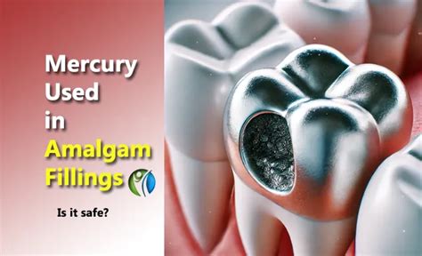 Type Of Mercury In Amalgam