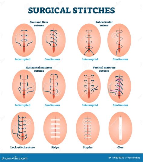 Type Of Surgical Stitches