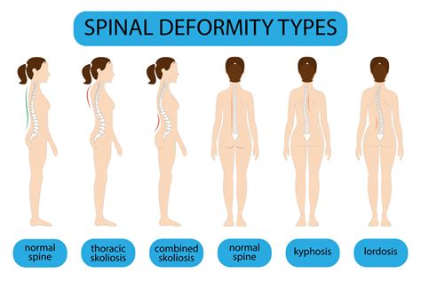 Types Of Backbone Problems