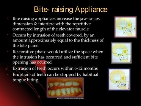 Types Of Bite Raising Appliance