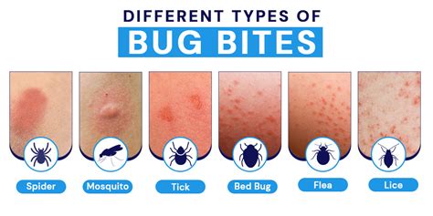 Types Of Bug Bites On Skin