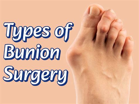 Understanding the Different Types of Bunion Surgery: Which Option is Right for You?