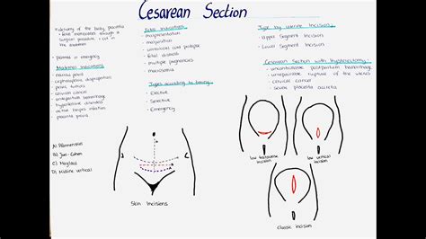 Types Of C Section Operation