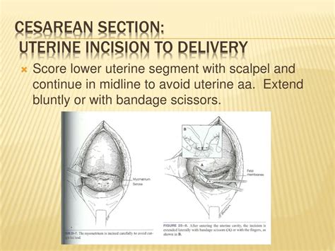 Types Of Cesarean Section Slideshare
