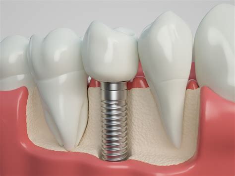 types of dental implants pdf