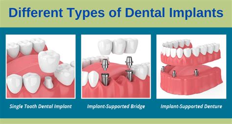 Types Of Dental Implants Slideshare