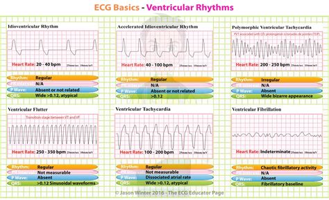 Types Of Ecg Rhythms