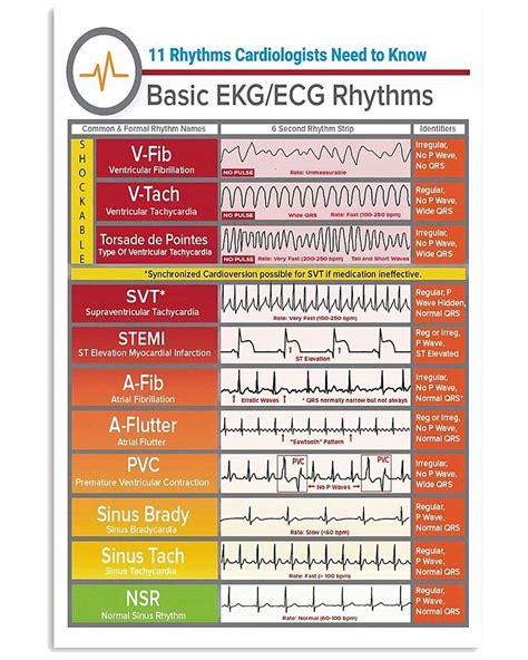 Types Of Ecg Strips